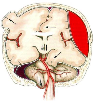 Brain herniation Subfalcian