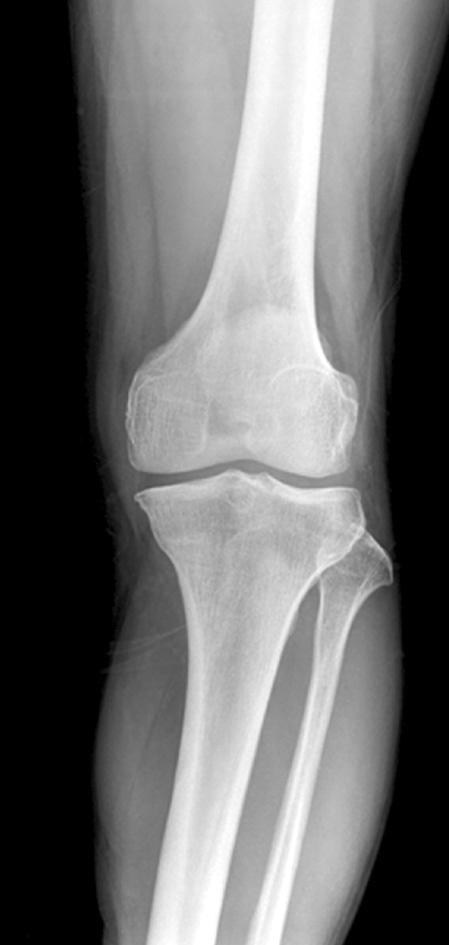 Ten months after the closing wedge osteotomy, radiographs show persistent genu recurvatum and loss of valgus correction.