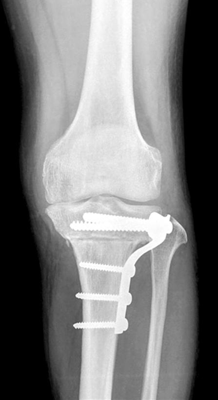 varum but severe genu recurvatum. The femorotibial angle was valgus 2 degrees and the tibial posterior slope was 15 degrees.