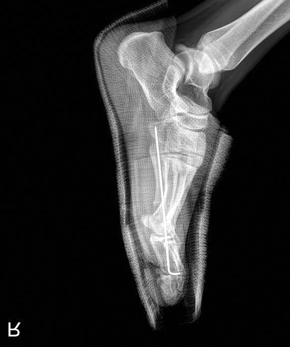 Gab-Lae Kim, et al. Effect of Weightbearing after Osteotomy 159 대상및방법 2009년부터 2015년까지본원에서통증을동반한소건막류진단하에원위부역위사형절골술을시행한후최소 1년이상추시가능하였던 52명의단순방사선사진과의무기록을대상으로하였다. 추시기간은최소 1년에서최대 3년 4개월로, 평균 1년 7개월이었다.