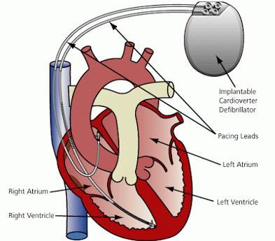 기구치료및수술요법 I. 심율동전환제세동기 (ICD, Implantable Cardioverter Defibrillator) 1.