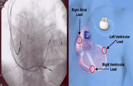 기구치료및수술요법 II. 심장재동기화치료 (CRT, Cardiac Resynchronization Therapy) 3. 기존의심박동기 (pacemaker) 나심율동전환제세동기 (ICD) 의기능향상이필요한경우 LVEF 35% 이고 NYHA III 또는거동가능한 IV 환자에서심조율의비율이 40% 이상인경우 4.