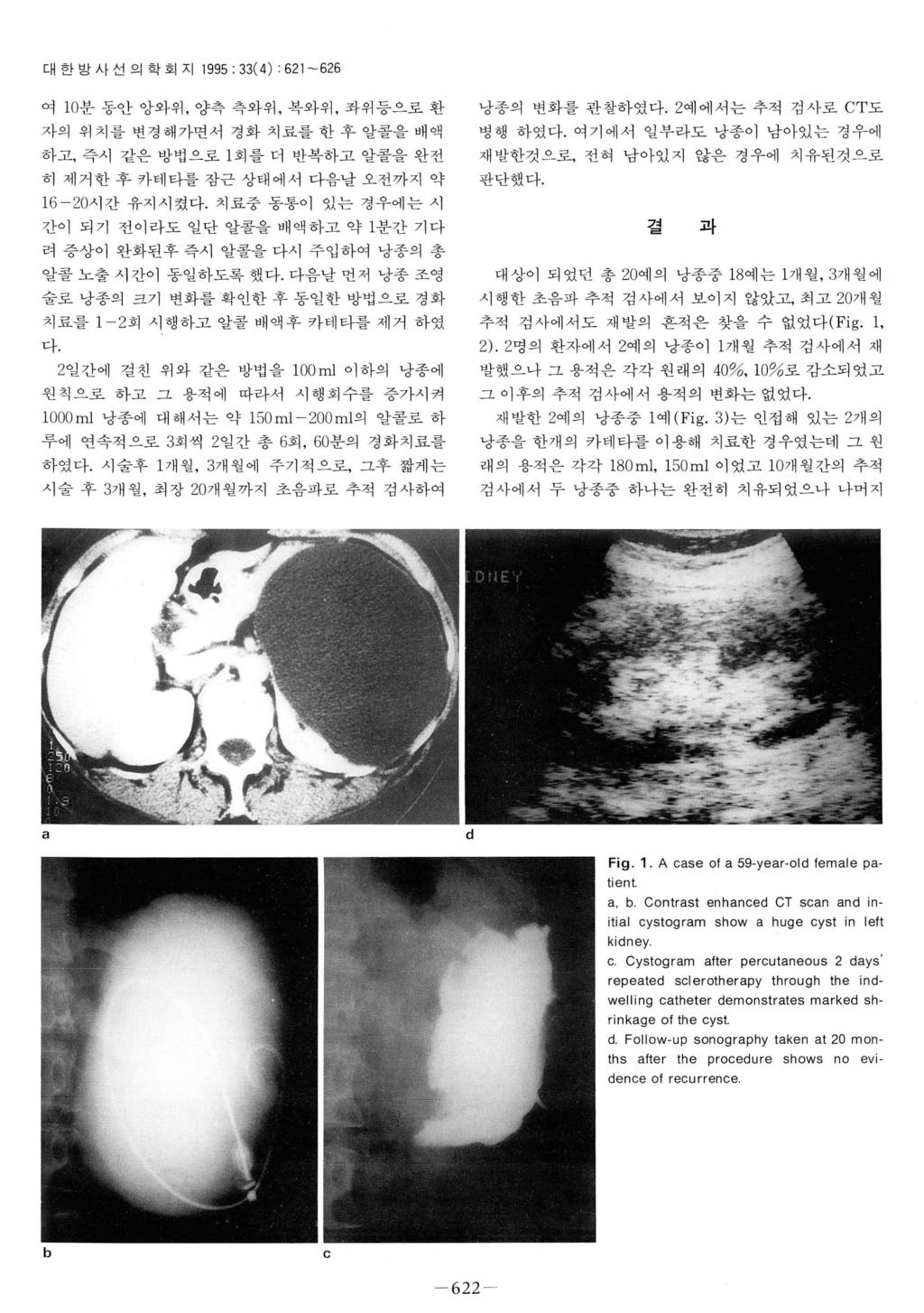 대한방사선의학회지 1995: 33( 4) : 621-626 여 10분동안앙와위, 양측측와위, 복와위, 좌위등으로환자의위치를변경해가면서경화치료를한후얄콜을배액하고, 즉시같은방법으로 l 회를더반복하고알콜을완전히제거한후카테타를잠근상태에서다음날오전까지약 낭종의변화를관찰하였다.2예에서는추적검사로 CT도병행하였다.