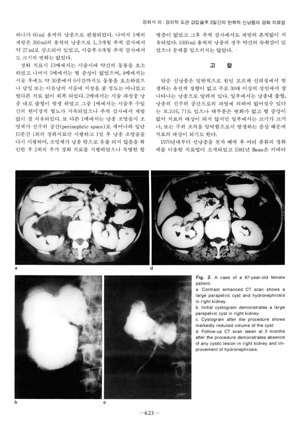 정회석외 경피적도관삽입술후 2 일간의반복적신낭종의경화치료법 하나가 60 ml 용척의낭종으로관찰되였다. 나머지 1 예의재발은 0m! 의용적의낭종으로 1, 3개월추적검사에서약 27 ml로감소되어있었고, 시술후 6개월추적검사에서도크기의변화는없었다.