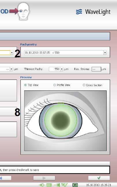 (Ring 외곽 / 내부지름, 각막수평절제깊이, Incision platform의길이 / 넓이 / 위치등 ) (6) 각막이식 (Keratoplasty)" 치료자료입력 - Keratoplasty" 모드를선택하면 Standard 치료방법들과비교해 Main Data ( 주자료 )" 와 Detail Data ( 세부자료 )" 값이크게다르게입력혹은수정될수있다.