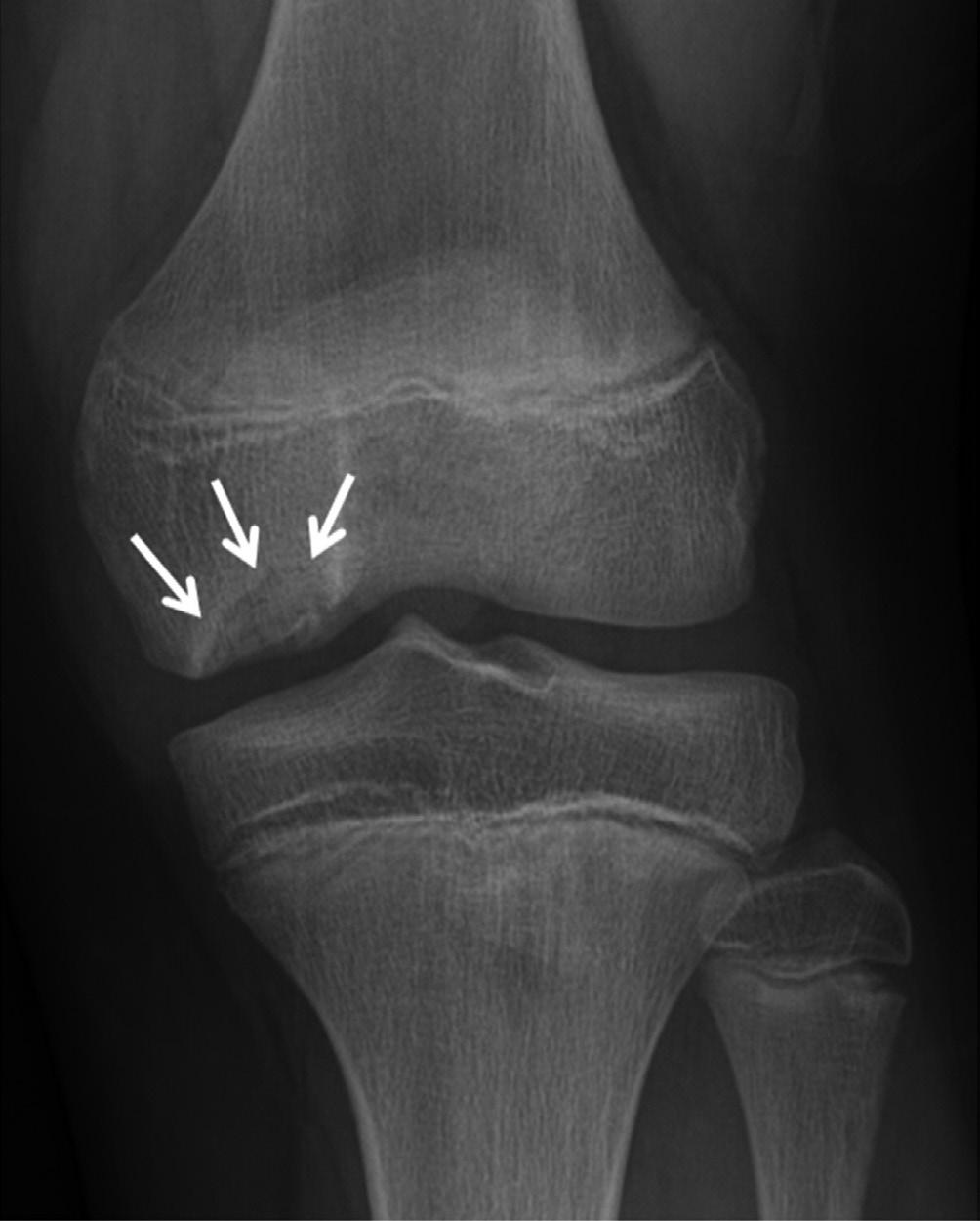 근골격방사선영상의빠르고쉬운판독 : 하지 Fig. 17. Segond fracture.. segond fracture is seen on the lateral aspect of the lateral tibial plateau on the anteroposterior radiograph (arrow).