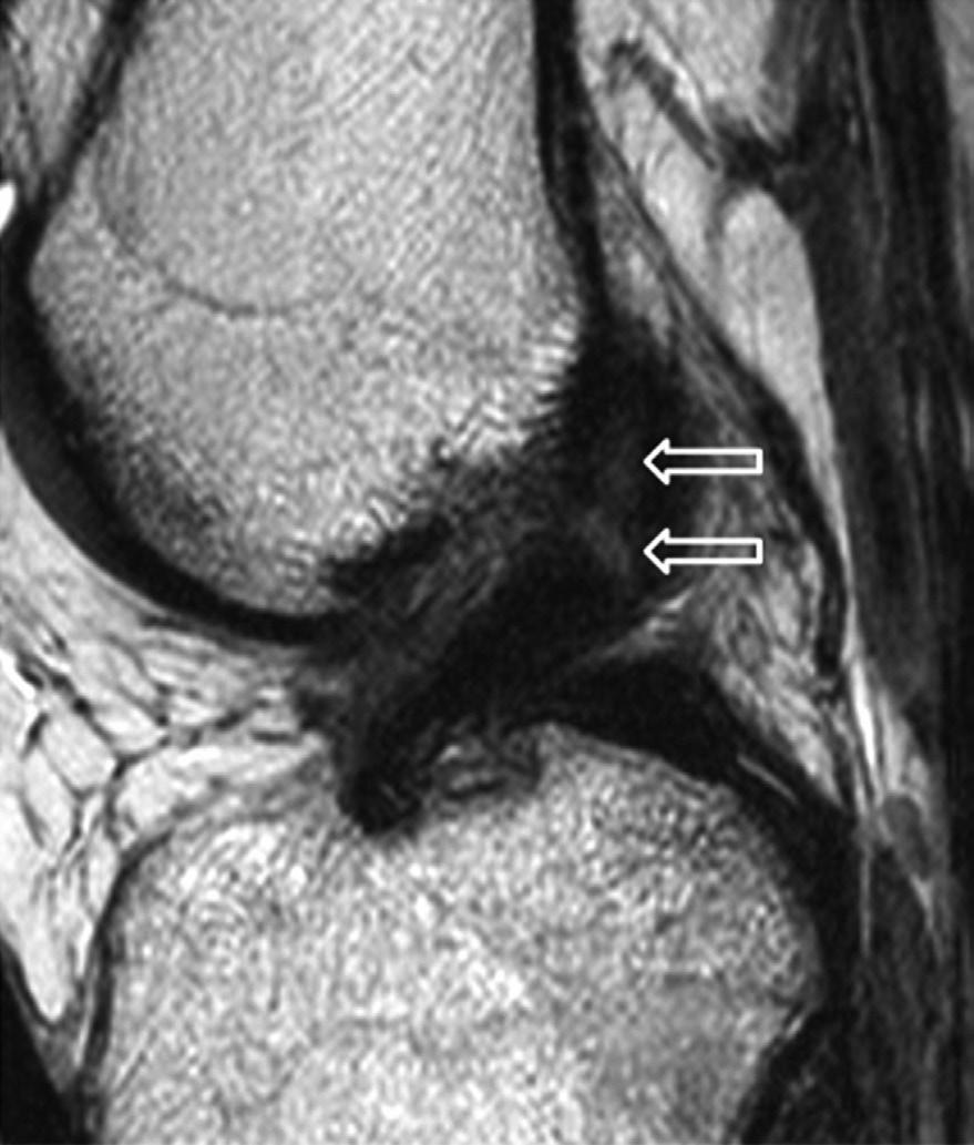 Osgood-Schlatter 병은연부조직부종과임상적진찰소견으로진단하며, 융합되지않은경골결절견인골단 (unfused tibial tuberosity apophyisis) 과구분해야한다 (28). 슬개골고위 (Patella lta) 및슬개골저위 (Patella aja) 슬개골고위는비정상적으로높게위치한슬개골이다.