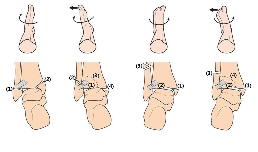 Subchondral cysts (arrows) and sclerosis are seen in the bilateral lateral tibial plateau. Lauge-Hansen 분류 Lauge-Hansen 분류는다음네가지손상기전에따른분류이다 (Fig. 22)(46).