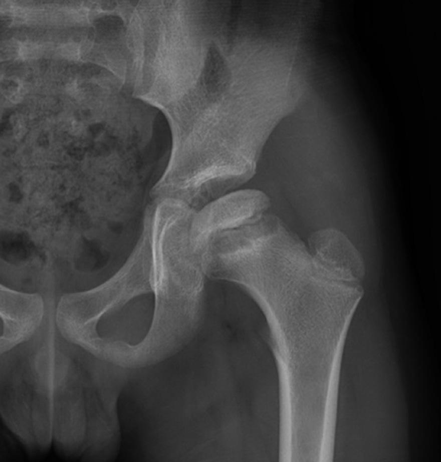 The left femoral head is displaced medially compared to the right femoral head. The growth plate of the left femur is also widened compared to that of the right femur.