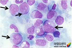 급성골수성백혈병 : 진단방법 - 혈액검사 - 말초혈액도말검사 - 골수검사 - 면역표현형검사