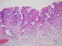 B. 과오종성폴립 1) 위바닥샘용종 (Fundic gland