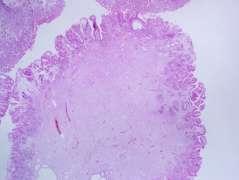 widely spaced, variably cystically dilated glands lined by normal or hyperplastic epithelium 2.inflammed edematous stroma 3.