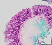 serrated adenoma (SSA) 48/F, colon polyp, 0.8x0.6x0.5cm Major pathologic findings 1. sessile growth 2.