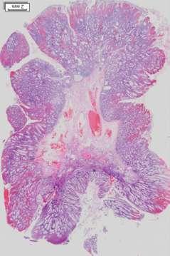 Mucosal prolapse polyp;
