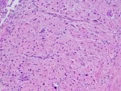The tumor is composed of sheets of uniform histiocyte-like cells with finely
