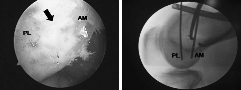 5 mm 해면골나사 (cancellous screw) 와와셔 (washer) 를이용하여견인매듭을미리묶은후나사에걸어원위부방향으로고정하여긴장을준후말단매듭을시행하여이중고정을하였다. 고정시 A B C D Fig. 3.