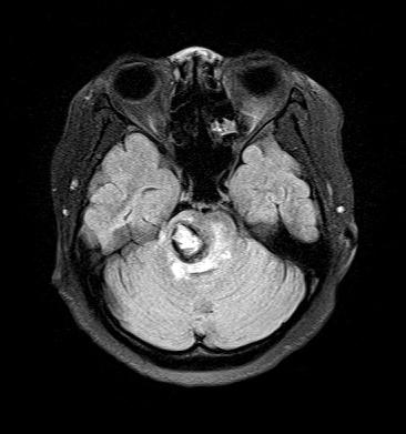 박수경외 3 인 :Cesarean section in pontine hemorrhage 43 Fig. 1. Brain magnetic resonance imaging before surgery shows about 2.1 cm hemorrhagic mass in the pons.
