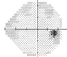 (optic nerve