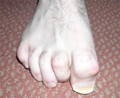 toe(2nd toe