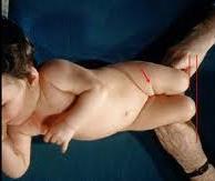 원인 : 태아의자궁내한정설이있다. 신생아를업어기르는사회에많이발생.