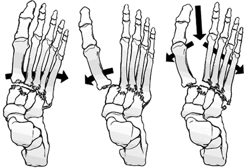 Lisfranc Joint Injuries: Diagnosis and Treatment 285 Fig. 1. Quenu and Kuss classification of Lisfranc joint injuries.