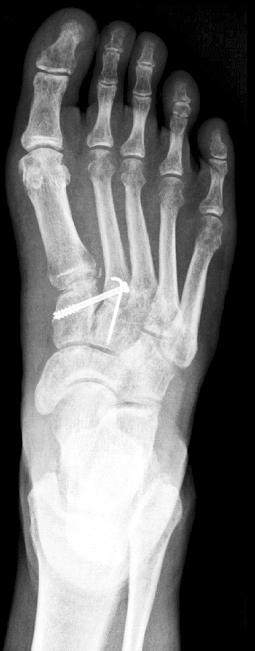 Closed reduction with internal fixation for a subtle Lisfranc joint injury.