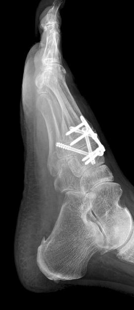 290 Hyun Seok Yim, et al. Fig. 10. Open reduction with internal fixation for Lisfranc joint injury using mini plate & screw. 되어널리사용되고있다 (Fig. 10).