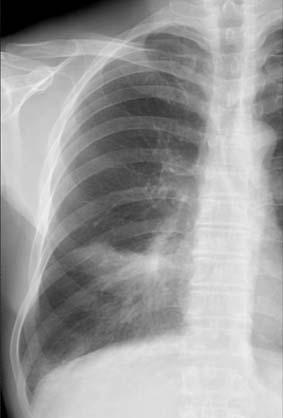 DW Sung : Radiographic findings of lung cancer: focus on