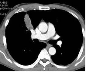 lower lung zone, impressed initially pneumonia.