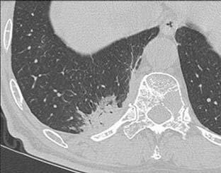 ir-bronchograms can be seen within the opacity and it broad based Cto the thoracic wall.