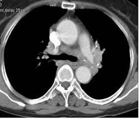 DW Sung : Radiographic findings of lung cancer: focus on atypical pattern Figure 6. denocarcinoma in a 57-year-old woman.