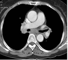 Radiographically, there is an absence of a primary parenchymal mass. 발생이증가하기때문이다. 2. 중심성종괴 1. 변연부종괴선암의 60-70 % 가변연부형태이며, 변연부종괴의 30-40 % 가선암이다. 비호흡기증상으로뼈통증, 허약, 소화불량, 식욕부진이잘나타나며, 종괴의크기가작아도초기에전이를잘한다.