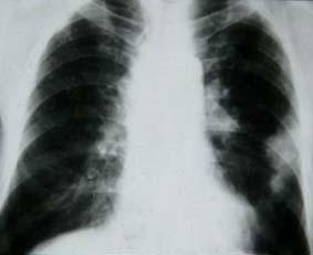 . Chest P after 14 years from shows a complete resolution of previous tuberculosis, but an irregular mass on the left mid-lateral lung zone, and