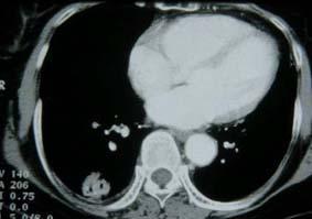 Solid type of a bronchioloalveolar cell carcinoma.. CT shows a mass on the right lower lobe with inner bubbly lucencies.