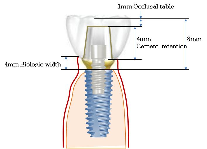 Fig. 2. Prosthesis-periodontal consideration factors of implant. (A) Fig. 3.