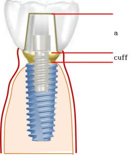 (B) Screw-retention type: Height from prosthesis-abutment junction to the top of screw (b).