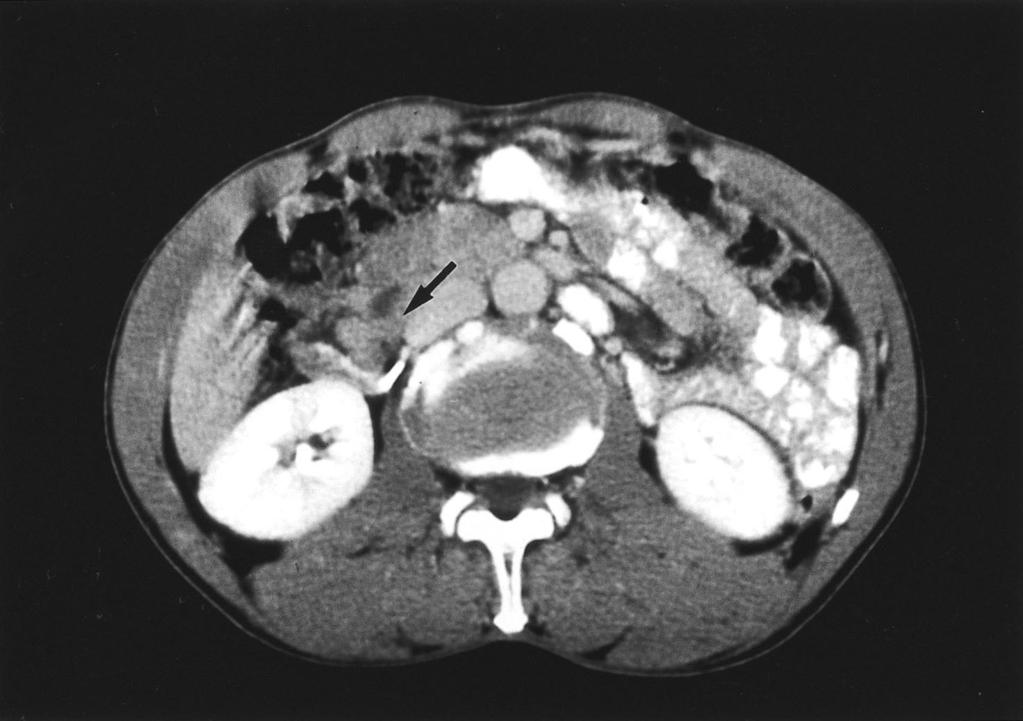 Sok Kyun Hong, et al : A case of carcinoid tumor of ampulla of vater presenting as asthmatic symptoms :, 57 : : 57 6 5 kg. :, 1998 l. :. :, 110/70 mmhg, 84 /, 20 / 36.7.,.,.,,,.,,. : 7,070/ mm3( 66.
