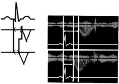 - Sung Soo Kim, et al. Ventricular dyssynchrony in patients with permanent pacemaker - A B Figure 1.