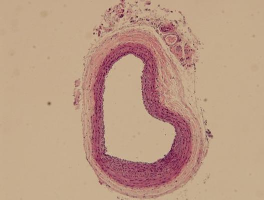 등과같은다양한사이토카인등이강력한 mitogen으로작용하여전구세포나평활근세포의활성을초래하게한다.