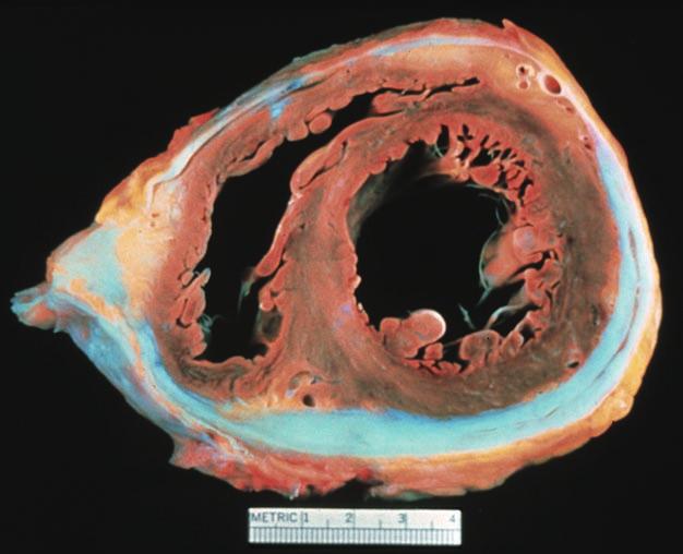 Constrictive pericarditis is caused by non-compliant pericardium.