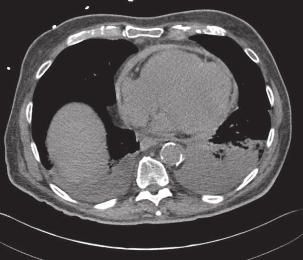 토막강좌 >>> 토막강좌 measured by computed tomography (CT), and CT is a very helpful tool to diagnose constriction in patients presenting with symptoms and signs of right heart failure (Figure 3).