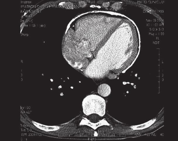 Therefore, the definite diagnosis of constriction must be based on unique noninvasive or invasive hemodynamic features.