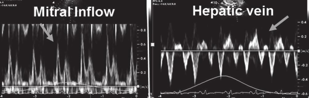 These features are shown as characteristic mitral inflow, tricuspid inflow, and hepatic vein flow Figure 3.