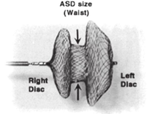 이와같은경피적폐쇄술의증가에는 device 의발달이주요한요인으로 2001 년 FDA 로부터안정성이인정된 Amplatzerseptaloccluder (AGA medical) 가그주인공이다 ( 그림