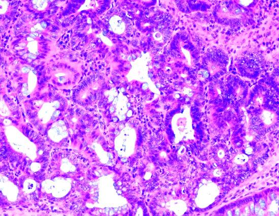 셋째, 만성염증반응과정중에염증 세포로부터생성되는과도한 cytokine, chemokine 들은 염증세포뿐만아니라상피세포에도세포성장, 이동, 분 화를유도한다 22).