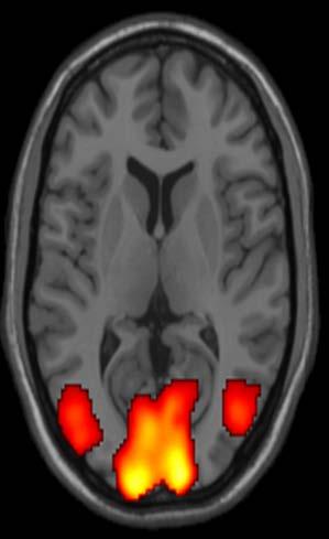뇌의기능을살펴보는방법 Functional MRI 기능적 MRI BOLD (blood-oxygenation level dependent) signal 어떤행동 -> neuronal activation -> cerebral blood