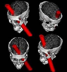 Phineas Gage case (1848) bilateral frontal lobe