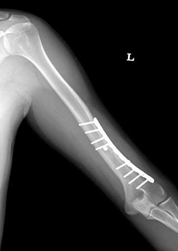 (C) Follow-up radiography 1 year after operation shows good bony union of the fracture without complications. Table 2.