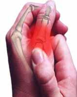 Physical Therapy and Rehabilitation: PT 10 2) Thumb a.