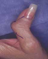 pollicis spasm & contracture b.